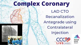 LAD CTO Recanalization Antegrade using Contralateral Injection - February 16, 2010 Webcast Video