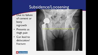 Part 6 - Hip & Knee Arthritis Webinar: Revision Hip Replacements