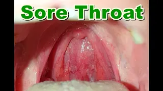 Normal vs Sore Throat | Pharyngitis