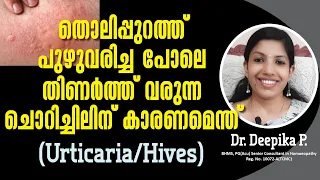 ശരീരത്തിൽ പുഴുവരിച്ച പോലെ ചൊറിഞ്ഞ് തിണർക്കുന്നതിന് കാരണമെന്ത്| Urticaria Treatment| Hives | Allergy