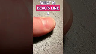 What is Beau’s Line on nail and its causes #shortvideo #shorts #reels #reel