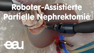 Roboter-Assistierte Partielle Nephrektomie