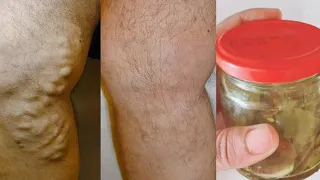 Say goodbay to varicose veins and joint pain with only bay leaf, which is 100% effective