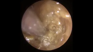 776 - Jaw Clenching Ear Wax Removal