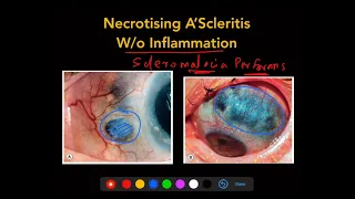 Scleritis - The Complete Course