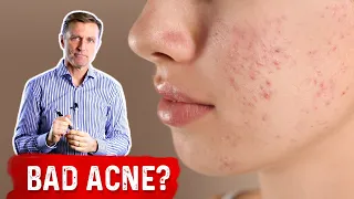 If Nothing is Working for Acne, Try This Acne Removal Treatment – Dr.Berg