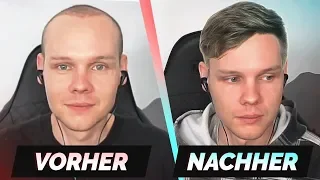 unsympathisch ZEIGT sich nach seiner Haartransplantation 👨‍🦲 | Stream Highlights