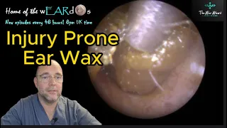 Injury Prone Ear Wax - 186 #ear #earwax #earwaxremoval #earcleaning #asmr #asmrearwax #satisfying