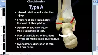 Skeletal fractures IV lower Limb  Prof  Dr  Mamdouh Mahfouz 720p