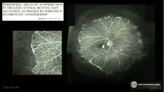 Ultra Widefield Angiography In Retinal Vein Occlusion, Szilard Kiss