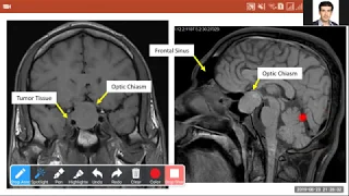 02  Pituitary MRI