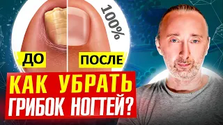 Как избавиться от грибка ногтей и стоп на 100%?