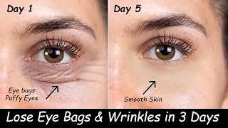 Remove Under Eyebags & Eye Wrinkles in 3 Days - Vaseline for Dark Circles, Carrot Gel & Eye Exercise