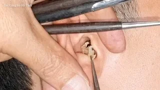 Earwax Removal by Safe Tools and Relaxing Music #Tóc_Công_Sở_Hà_Tĩnh 29