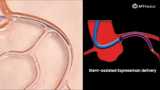 Expressman™ Guiding Extension Catheter Operation Tutorial