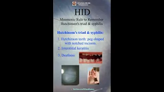 Hutchinson's Triad & Syphilis. HID: Mnemonic Rule to Remember Hutchinson's Triad & Syphilis.