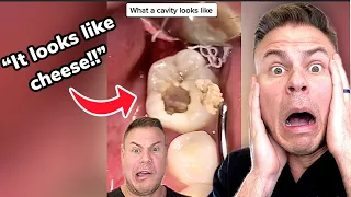Dentist Reacts! THIS Happens When You Get A Cavity!