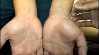 張孟超醫師-針灸(木關穴，骨關穴+動氣療法)右足跟痛 right heel pain