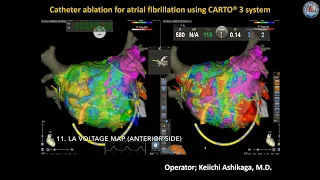 Mitral regurgitation improvement after successful AF ablation by using a 3D mapping system