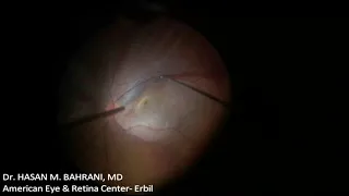 Temporary Keratoprosthesis & Vitrectomy for Retinal Detachment PVR C3 Dr. Hasan M. Bahrani