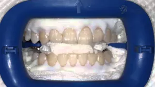 Endlich weiße Zähne: Wie funktioniert Bleaching beim Zahnarzt?
