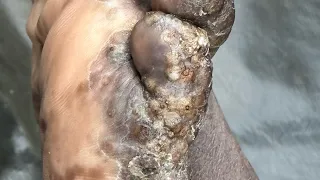 Moses's heavily jiggered left foot (part A) - FULL VIDEO, subscribe to www.riseupsociety.net