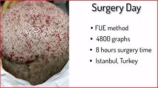 Hair Transplant First 10 Days - Post Op Recovery I Things to DO & AVOID