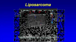 Ultrasonography of Superficial Soft Tissue Masses