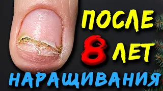 Dangerous!🚨 Nails fell off. Harm Building! 8 years later.Onycholysis.❌Ruined Nails.Terrible manicure