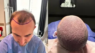 hair transplant in Bellus clinic / 4200 grafts