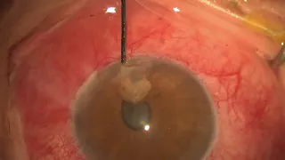 Corneal Laceration Repair  HD 1080p