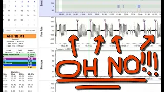 Periodic Breathing (Central Apneas) with CPAP.