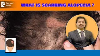 6 Causes Why NO HAIR GROWTH after Hair Treatment|Scarring Alopecia-Dr.Deepak Devakar|Doctors' Circle