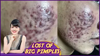 Lost of big pimples| Điều trị mụn hiệu quả số 1 TPHCM | Hiền Vân Spa |Mụn nang, mụn đầu đen|540