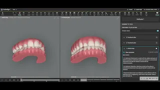 Expansion of the DENTAL arch with braces and NO palatal expander or headgear