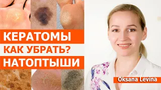 Кератомы и натоптыши как убрать. Есть отличное средство