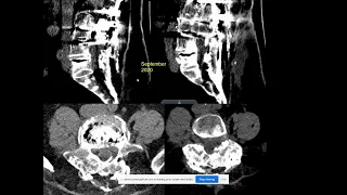 Interesting case: fracture through a lumbar fusion mass
