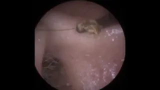 Ear Hook Ear Wax Removal By Doctor Rada