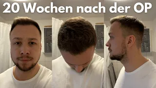 Haartransplantation - 20 Wochen nach der OP - Worauf achten bei der Haarlinie?