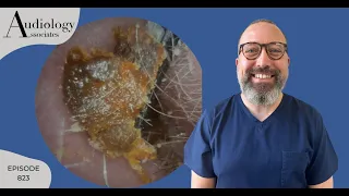 CHEWING GUM EAR WAX & KERATIN PEELS- EP823