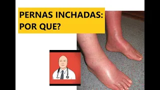 As 9 causas principais de pernas inchadas, com sinais de alerta para ver o médico.