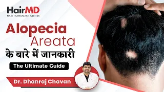 Ultimate Alopecia Areata Guide | Alopecia Areata के बारे में जानकारी | HairMD, Pune