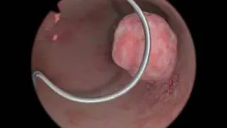 Polypectomy / Polyp Removal - Virtual Reality Simulation for Endoscopic Surgery