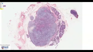 Salivary gland: Pleomorphic adenoma Microscopy - Talking slide