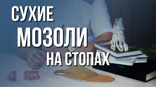 Сухие мозоли на стопе – как лечить?