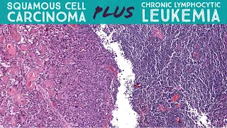 BAD squamous cell carcinoma in chronic lymphocytic leukemia patient (AIP France 2021 case 8)