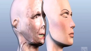 3D printing used in full face transplants