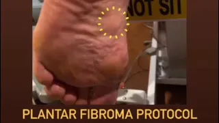 5-step protocol for a targeted ultrasound of a plantar fibroma in the foot