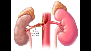 УЗИ сосудов почек. Сморщенная правая почка. Стеноз левой почечной артерии