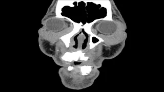 HN C8 Orbital Lymphoma (B)